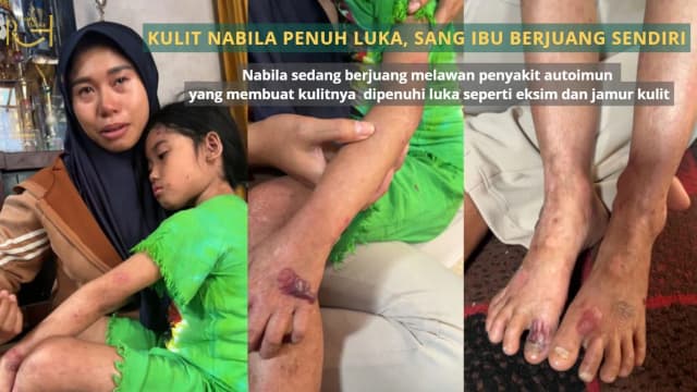 Kulit Nabila Penuh Luka Sang Ibu Berjuang Sendiri